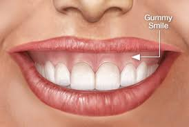 Harmonização Orofacial Sorriso Gengival  Procedimentos Tradicionais da HOF