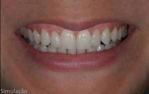 Read more about the article Lentes Dentais associadas à HOF (Harmonização Orofacial)
