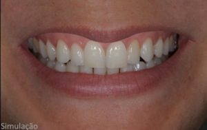 Leia mais sobre o artigo Lentes Dentais associadas à HOF (Harmonização Orofacial)