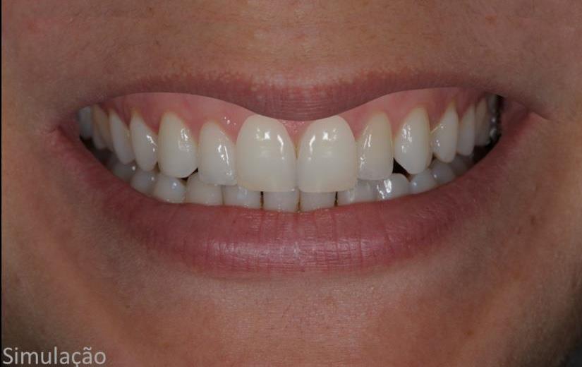 You are currently viewing Lentes Dentais associadas à HOF (Harmonização Orofacial)
