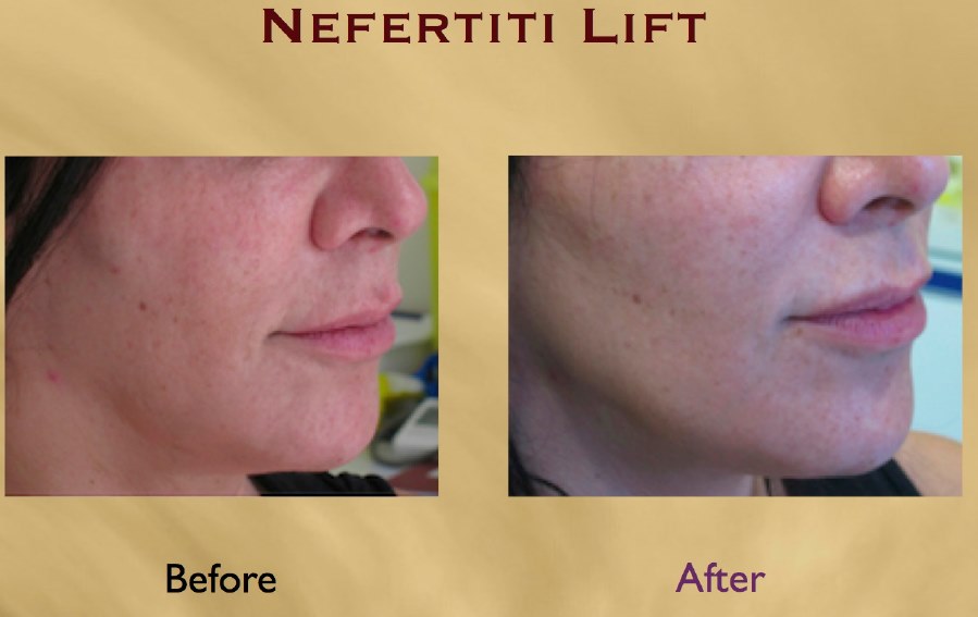 Tratamento da Nefertiti  antes e depois