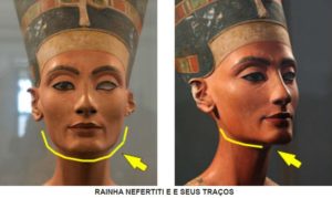 Read more about the article Tratamento da Nefertiti – Toxina Botulínica no Músculo Platisma