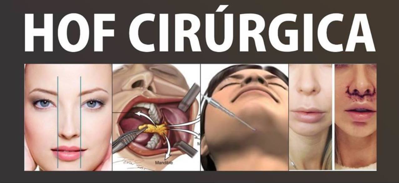 You are currently viewing As 4 Cirurgias da Harmonização Orofacial – HOF Cirúrgica