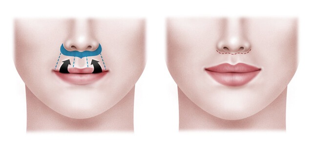 Cirurgias de Lábios Lip Lift