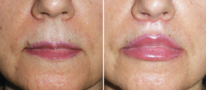 Read more about the article Lip Lift ou Lifting de Lábios – O procedimento menos conhecido que dura mais do que o preenchimento labial