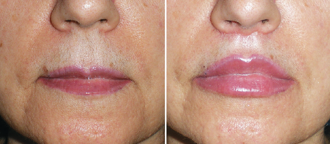 You are currently viewing Lip Lift ou Lifting de Lábios – O procedimento menos conhecido que dura mais do que o preenchimento labial