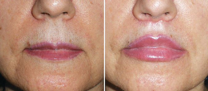 No momento, você está visualizando Lip Lift ou Lifting de Lábios – O procedimento menos conhecido que dura mais do que o preenchimento labial