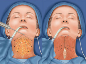 Read more about the article Lipo de Papada: Conheça a lipoaspiração que elimina a gordura do pescoço e papada