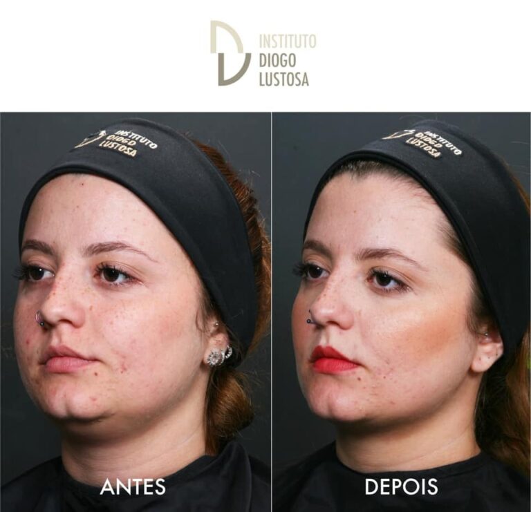 Lipoplastias Faciais - 3 técnicas feitas por Dentistas