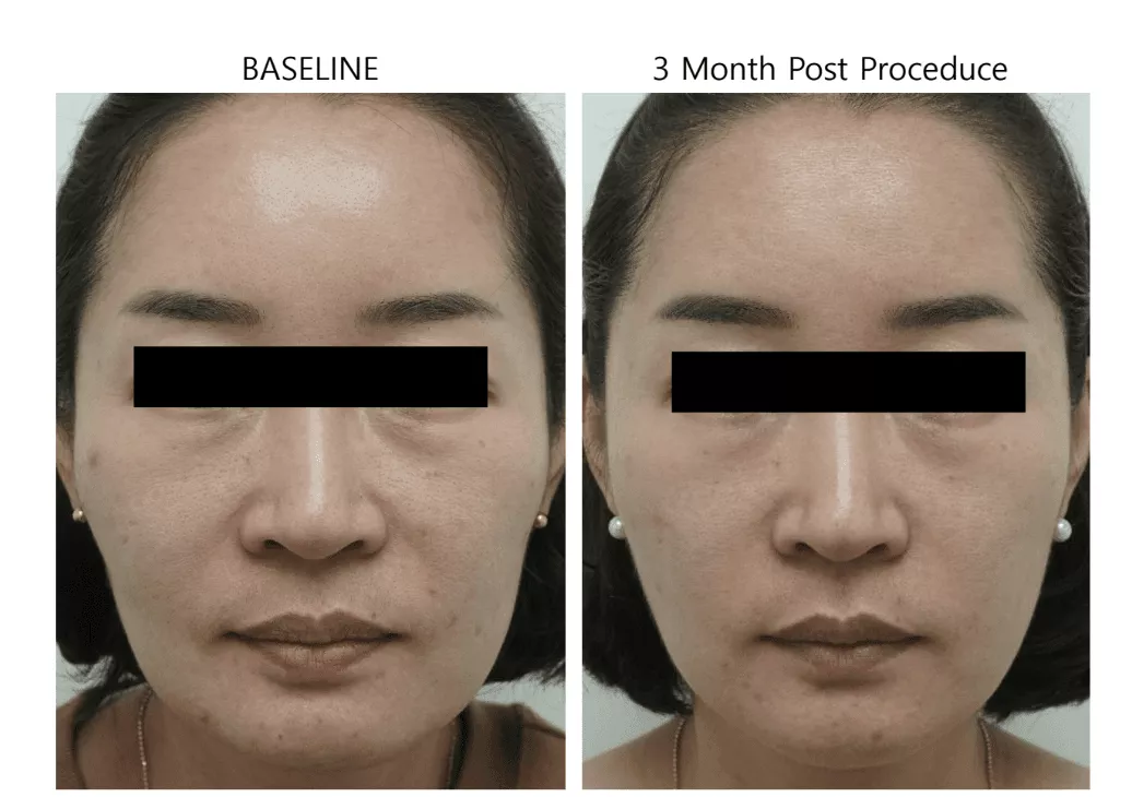 Ultraformer III – Conheça este aparelho para tratar flacidez