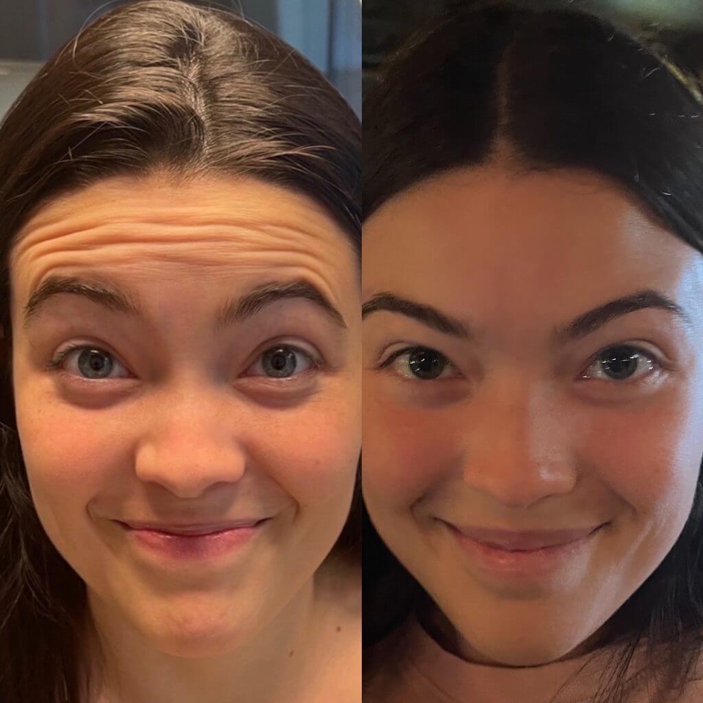 Baby Botox Antes e Depois