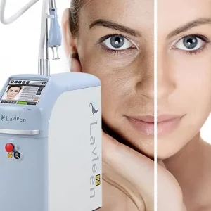 Read more about the article Conheça o Laser Lavieen e o efeito BB Cream para pele e melasma