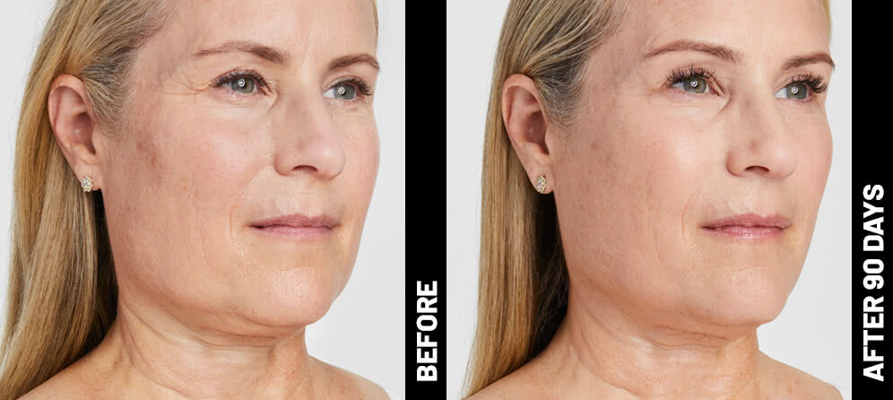 Ultherapy Antes e Depois