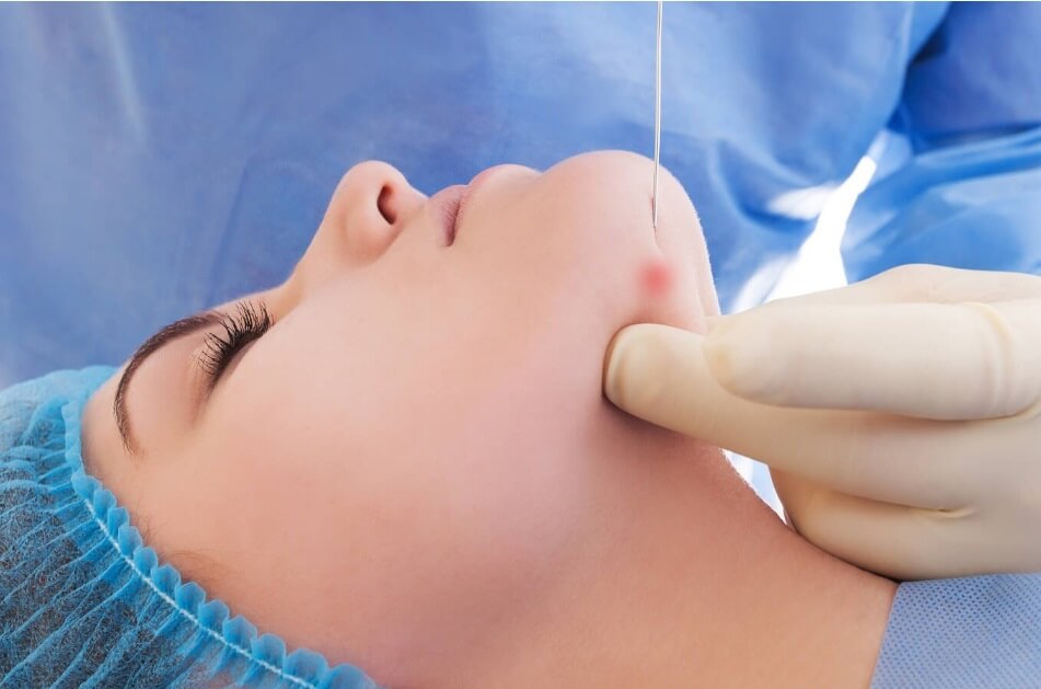 Laser Lift, Endolift ou Lipolaser – Conheça o Lifting Facial com Fibra Ótica