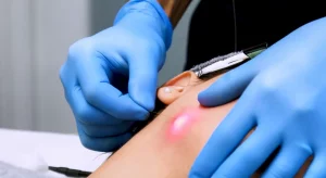 Leia mais sobre o artigo Laser Lift, Endolift ou Lipolaser – Conheça o Lifting Facial com Fibra Ótica